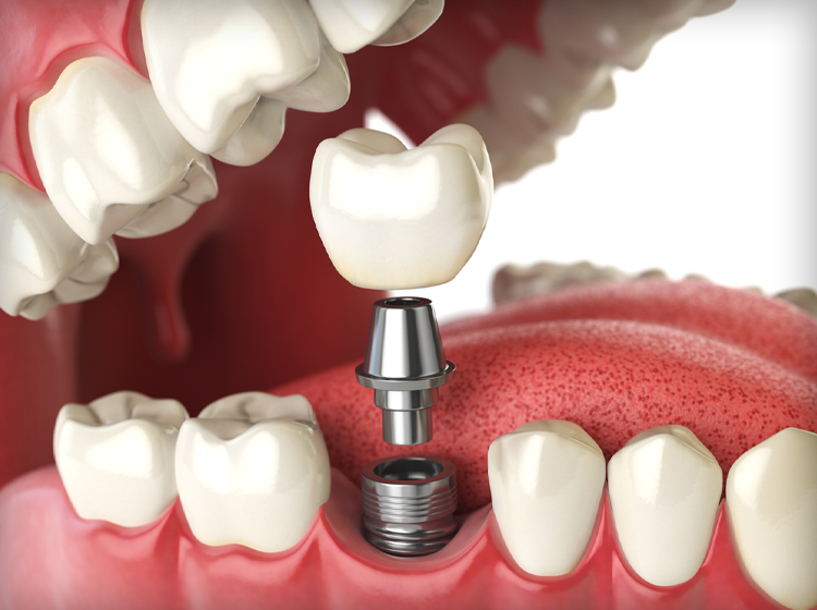 Dental Implants