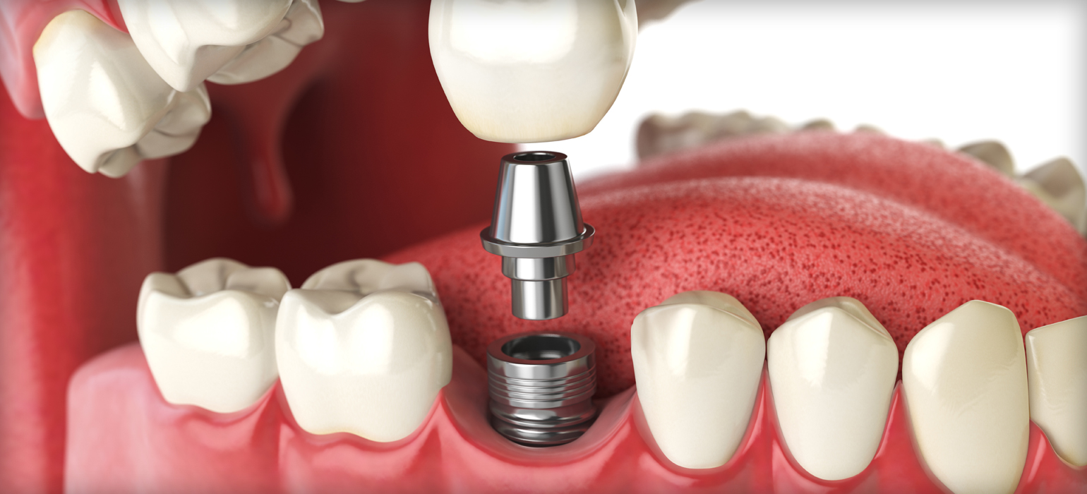 Dental Implants